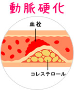 動脈硬化